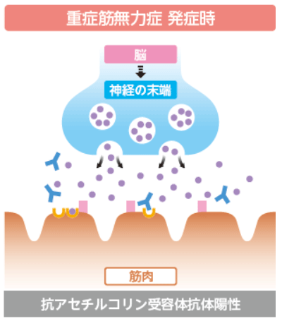 重症筋無力症発症時の挿絵