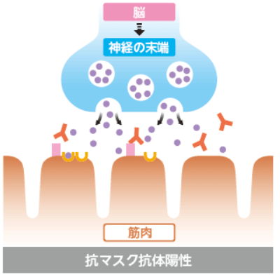 重症筋無力症発症時の挿絵